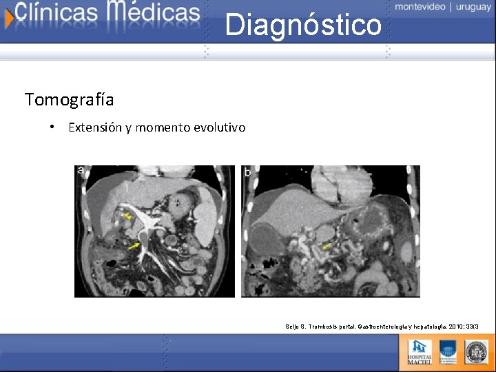 Diagnóstico Tomografía • Extensión y momento evolutivo Seijo S. Trombosis portal. Gastroenterologia y hepatología.