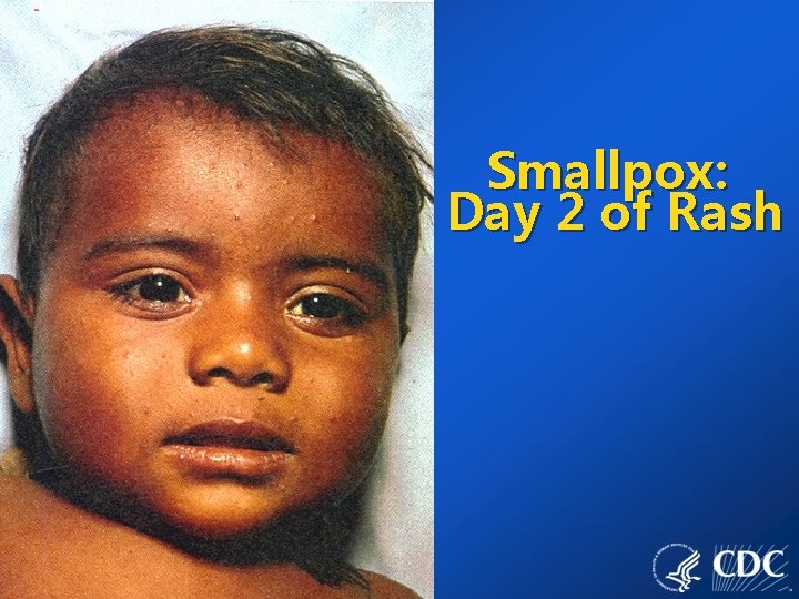 Smallpox: Day 2 of Rash 