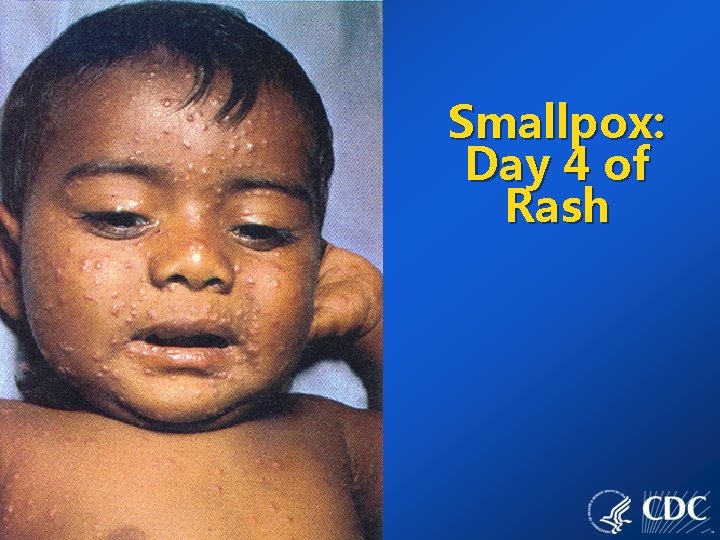 Smallpox: Day 4 of Rash 