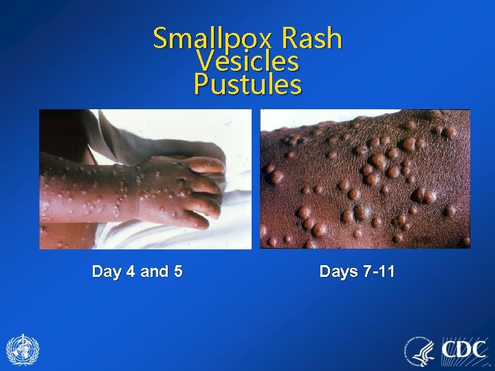 Smallpox Rash Vesicles Pustules Day 4 and 5 Days 7 -11 