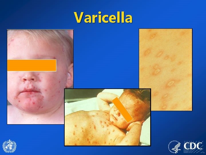 Varicella 