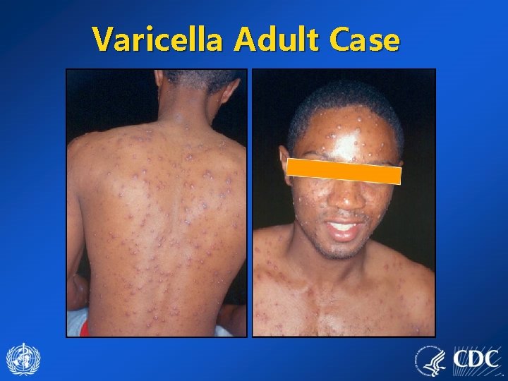Varicella Adult Case 