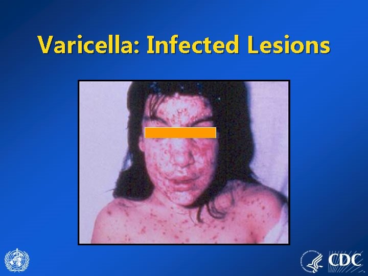 Varicella: Infected Lesions 