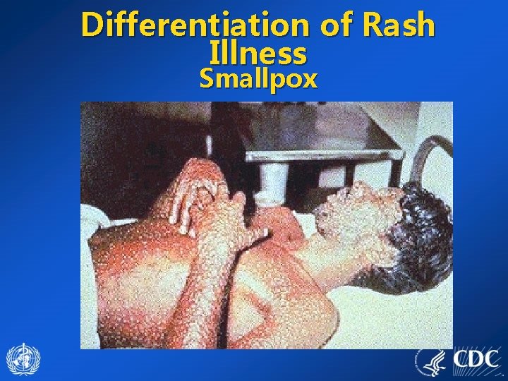 Differentiation of Rash Illness Smallpox 