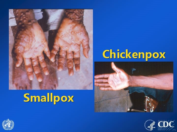 Chickenpox Smallpox 