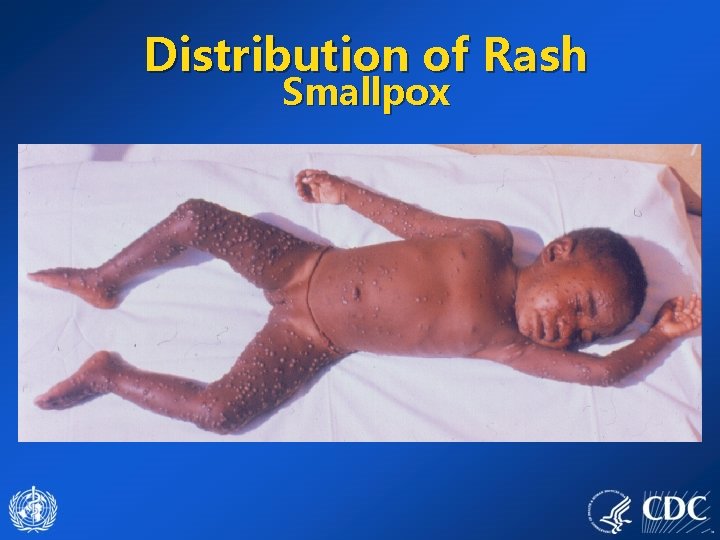 Distribution of Rash Smallpox 