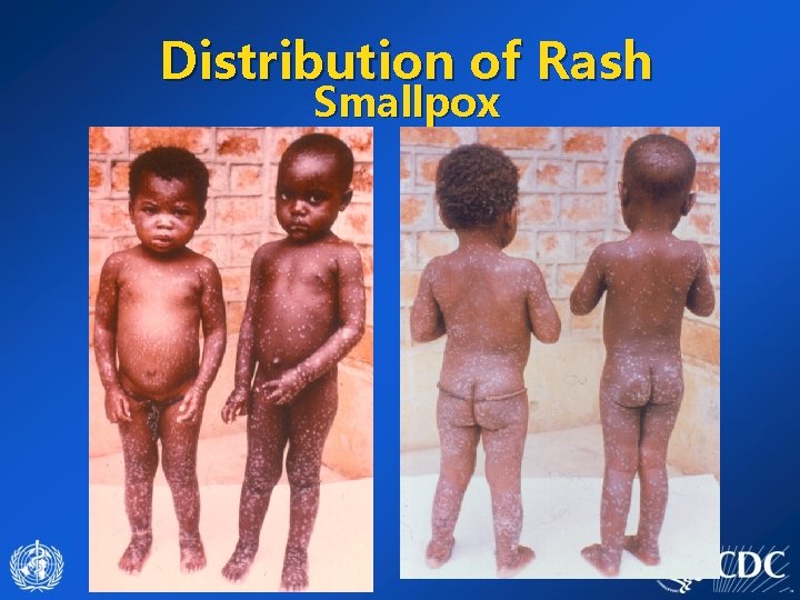 Distribution of Rash Smallpox 