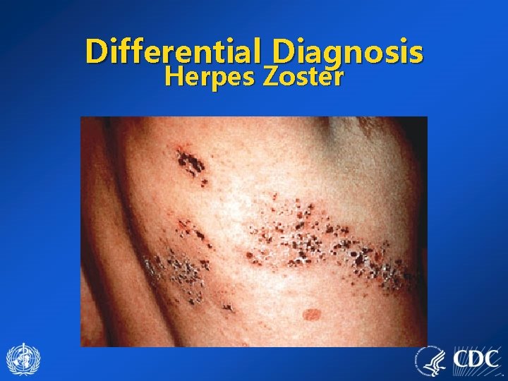 Differential Diagnosis Herpes Zoster 