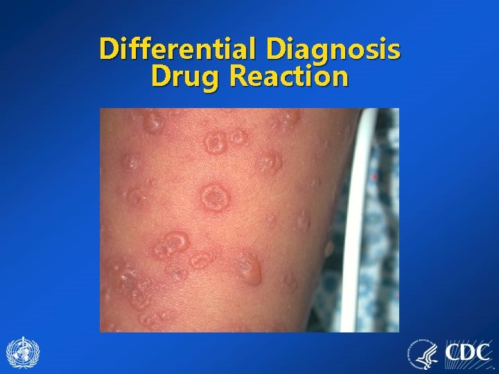 Differential Diagnosis Drug Reaction 