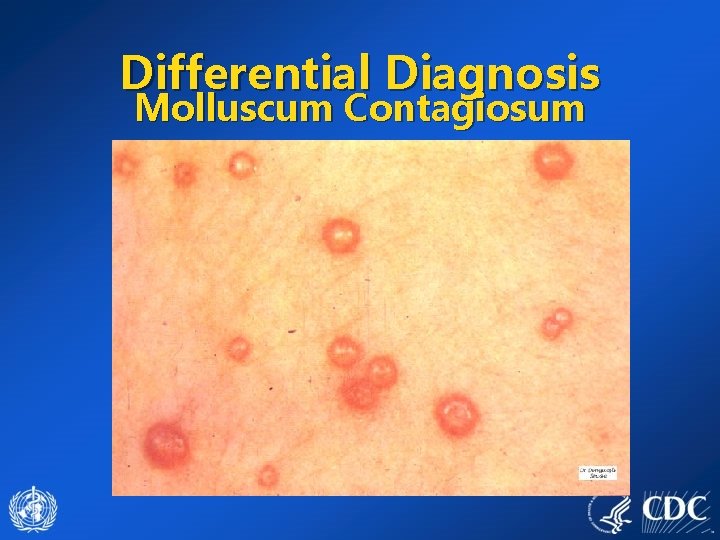 Differential Diagnosis Molluscum Contagiosum 