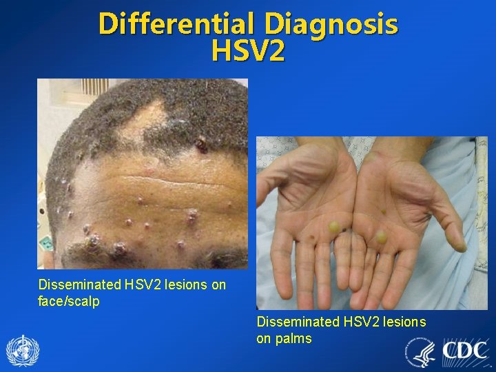 Differential Diagnosis HSV 2 Disseminated HSV 2 lesions on face/scalp Disseminated HSV 2 lesions