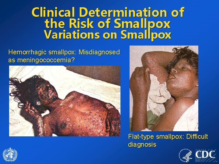 Clinical Determination of the Risk of Smallpox Variations on Smallpox Hemorrhagic smallpox: Misdiagnosed as