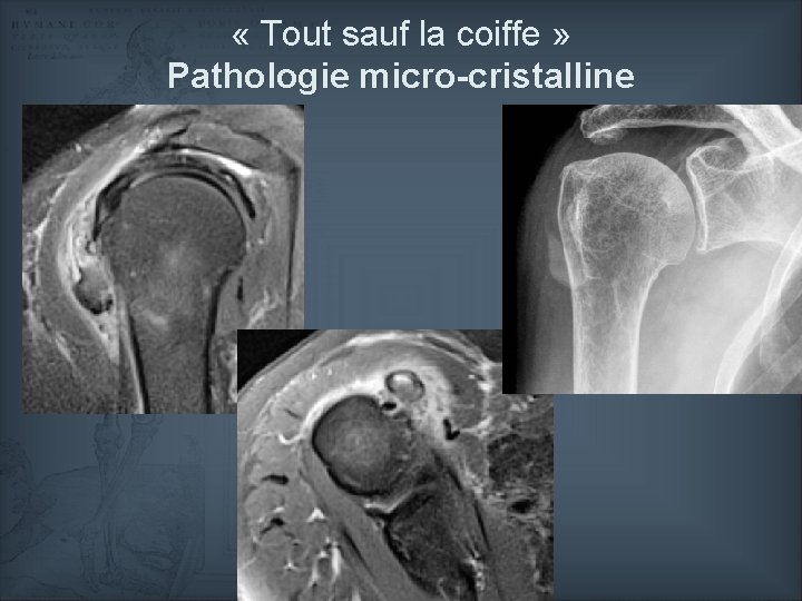  « Tout sauf la coiffe » Pathologie micro-cristalline 