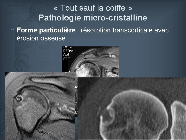  « Tout sauf la coiffe » Pathologie micro-cristalline Forme particulière : résorption transcorticale