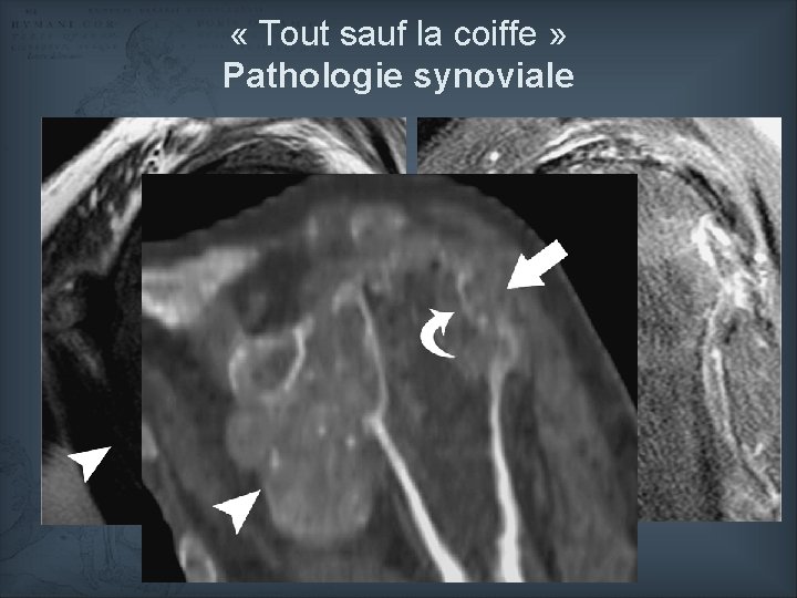  « Tout sauf la coiffe » Pathologie synoviale © Farid, EJR 2008 