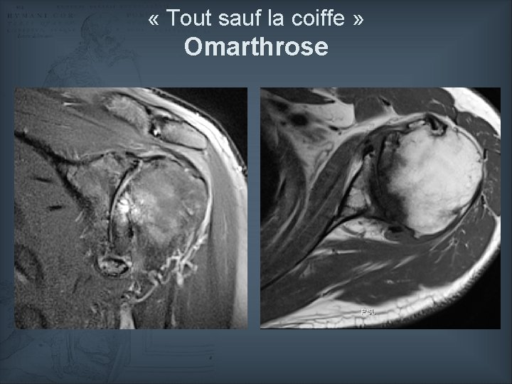  « Tout sauf la coiffe » Omarthrose 