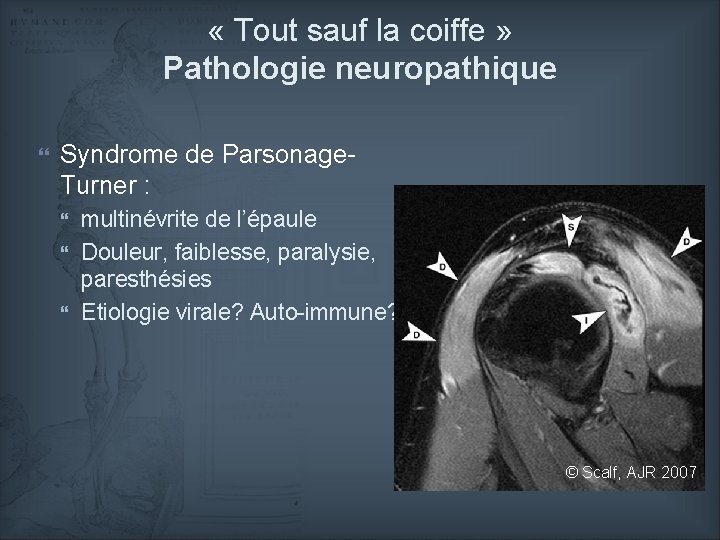  « Tout sauf la coiffe » Pathologie neuropathique Syndrome de Parsonage. Turner :