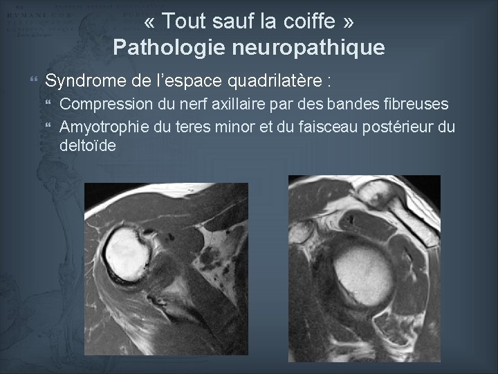  « Tout sauf la coiffe » Pathologie neuropathique Syndrome de l’espace quadrilatère :