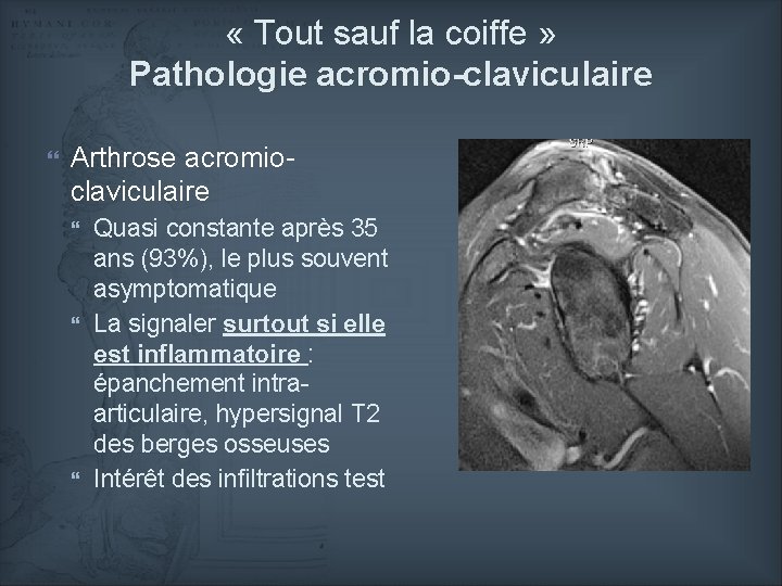  « Tout sauf la coiffe » Pathologie acromio-claviculaire Arthrose acromioclaviculaire Quasi constante après