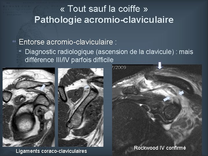  « Tout sauf la coiffe » Pathologie acromio-claviculaire Entorse acromio-claviculaire : Diagnostic radiologique