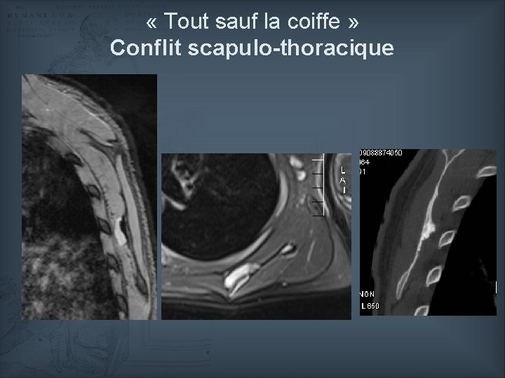  « Tout sauf la coiffe » Conflit scapulo-thoracique 