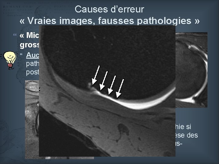 Causes d’erreur « Vraies images, fausses pathologies » « Micro-géodes » de la grosse