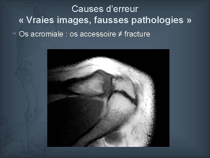 Causes d’erreur « Vraies images, fausses pathologies » Os acromiale : os accessoire ≠