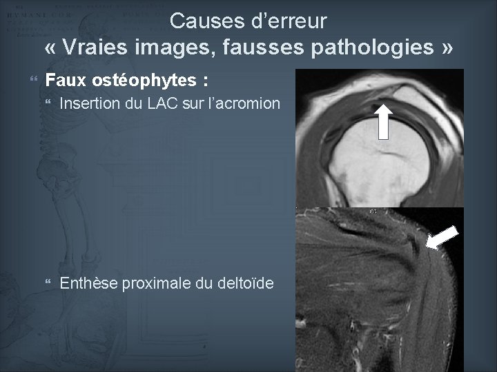 Causes d’erreur « Vraies images, fausses pathologies » Faux ostéophytes : Insertion du LAC