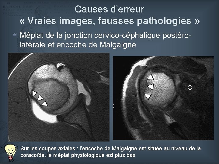 Causes d’erreur « Vraies images, fausses pathologies » Méplat de la jonction cervico-céphalique postérolatérale