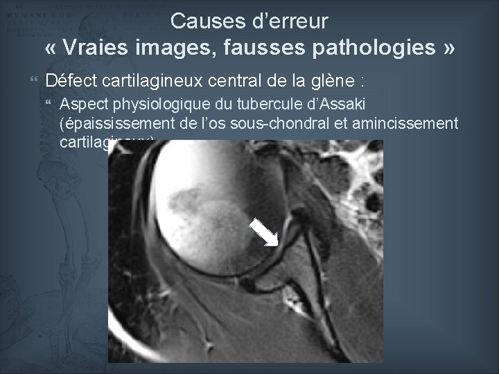 Causes d’erreur « Vraies images, fausses pathologies » Défect cartilagineux central de la glène