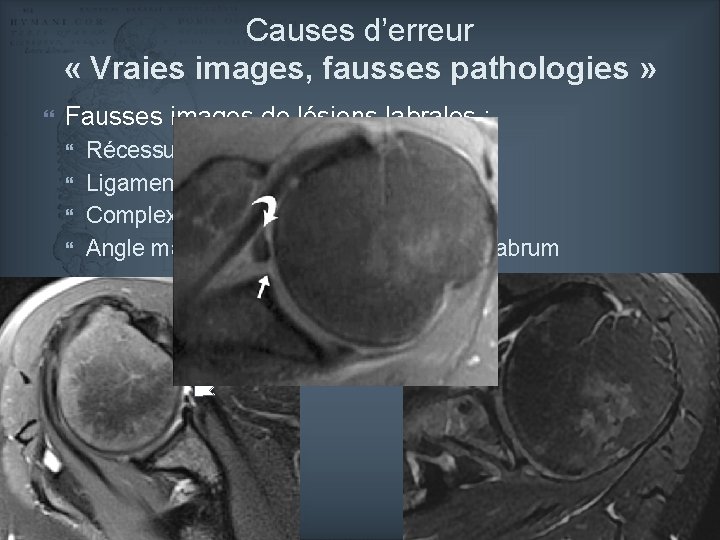 Causes d’erreur « Vraies images, fausses pathologies » Fausses images de lésions labrales :