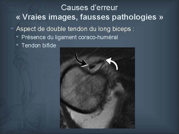 Causes d’erreur « Vraies images, fausses pathologies » Aspect de double tendon du long