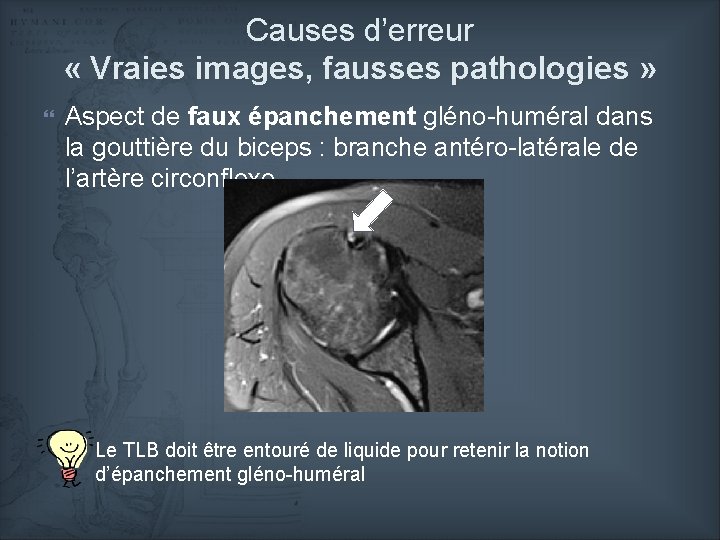 Causes d’erreur « Vraies images, fausses pathologies » Aspect de faux épanchement gléno-huméral dans