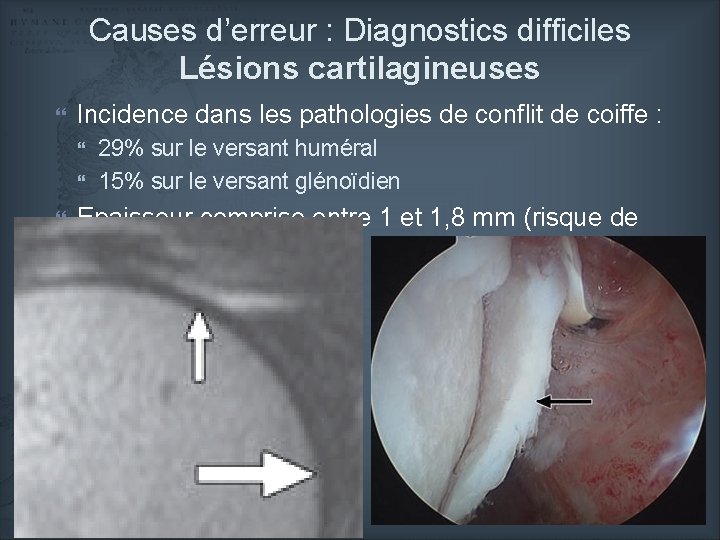 Causes d’erreur : Diagnostics difficiles Lésions cartilagineuses Incidence dans les pathologies de conflit de