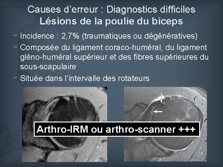 Causes d’erreur : Diagnostics difficiles Lésions de la poulie du biceps Incidence : 2,