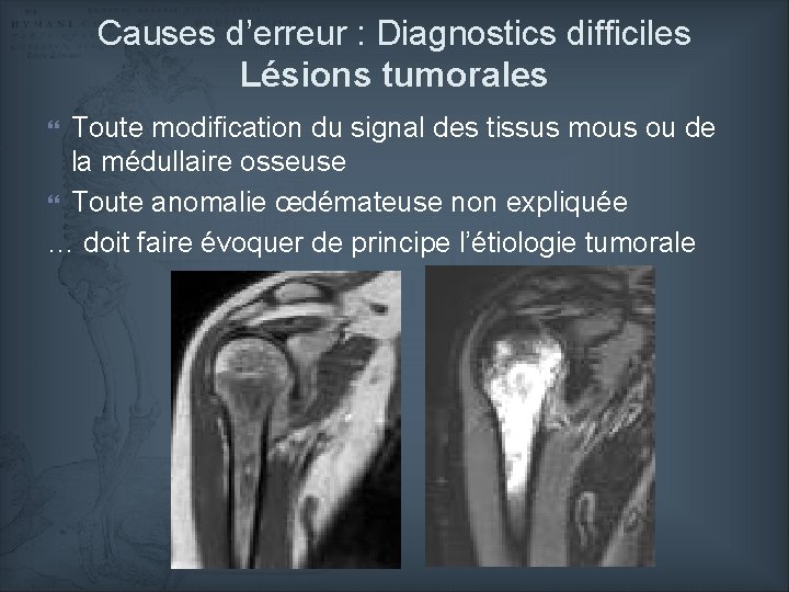 Causes d’erreur : Diagnostics difficiles Lésions tumorales Toute modification du signal des tissus mous