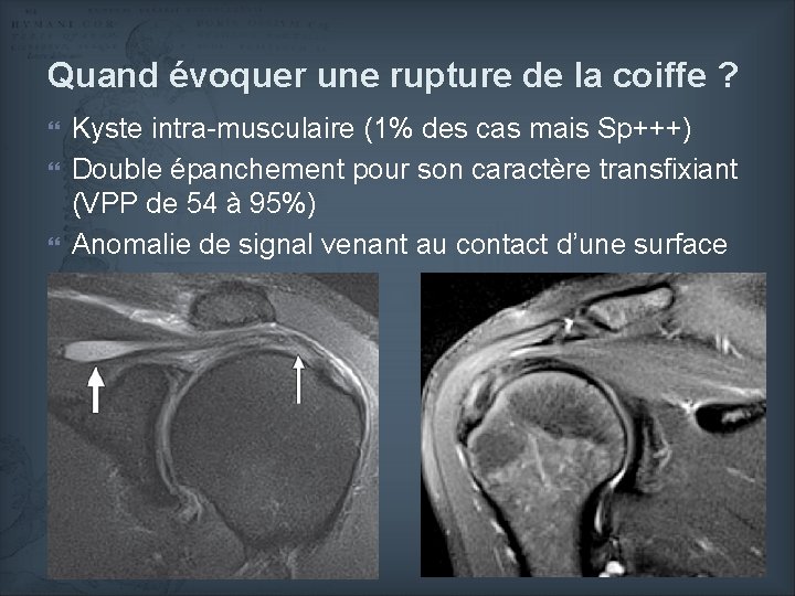 Quand évoquer une rupture de la coiffe ? Kyste intra-musculaire (1% des cas mais