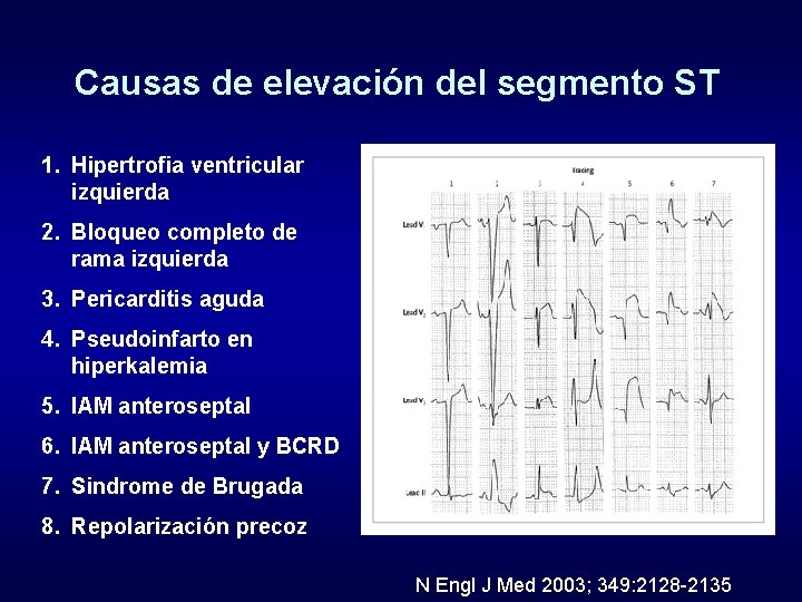 Causas de elevación del segmento ST 1. Hipertrofia ventricular izquierda 2. Bloqueo completo de