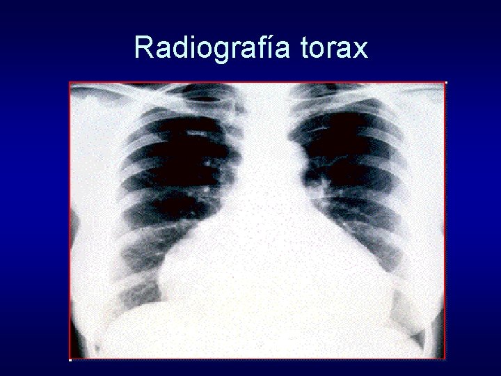 Radiografía torax 