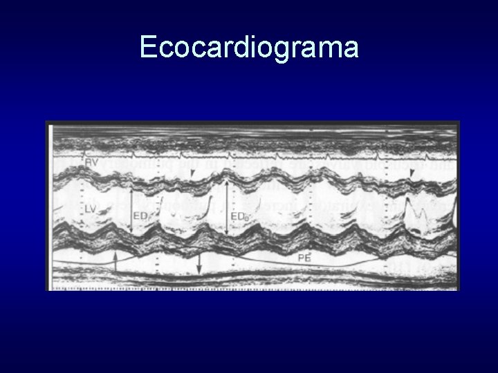 Ecocardiograma 