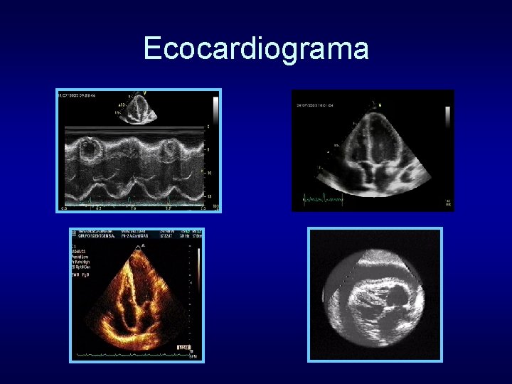 Ecocardiograma 