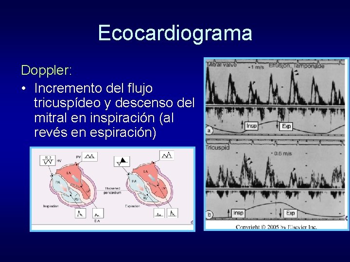 Ecocardiograma Doppler: • Incremento del flujo tricuspídeo y descenso del mitral en inspiración (al