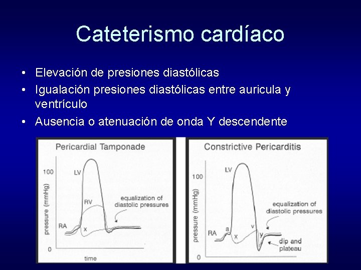 Cateterismo cardíaco • Elevación de presiones diastólicas • Igualación presiones diastólicas entre auricula y