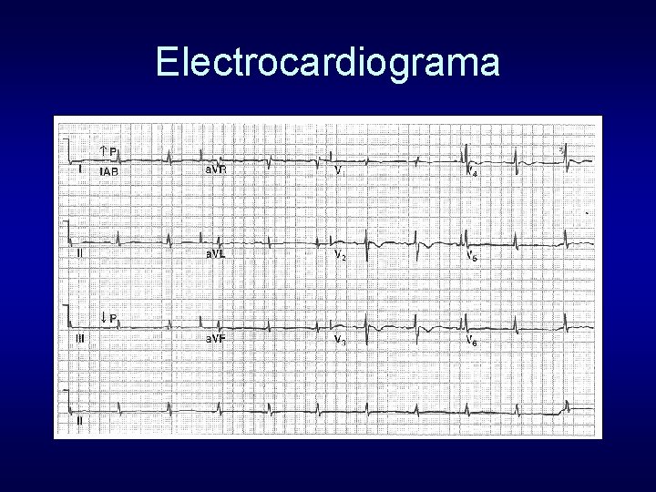 Electrocardiograma 