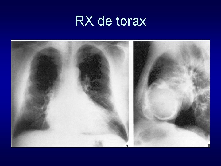 RX de torax 