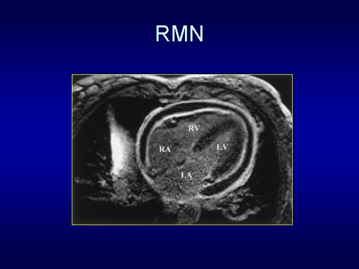 RMN 