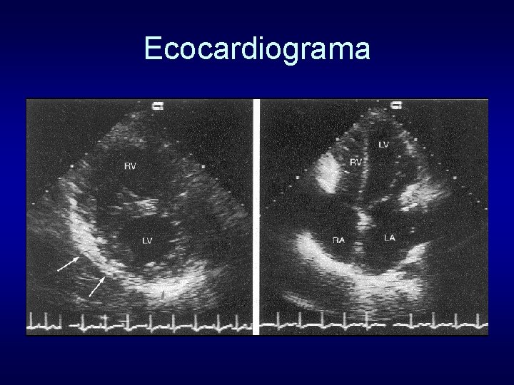 Ecocardiograma 