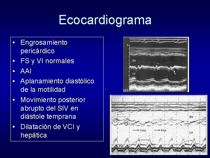 Ecocardiograma • Engrosamiento pericárdico • FS y VI normales • AAI • Aplanamiento diastólico