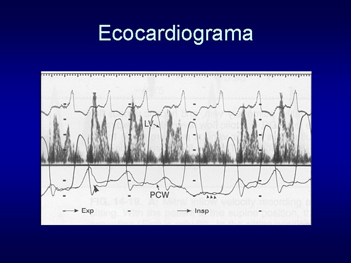 Ecocardiograma 