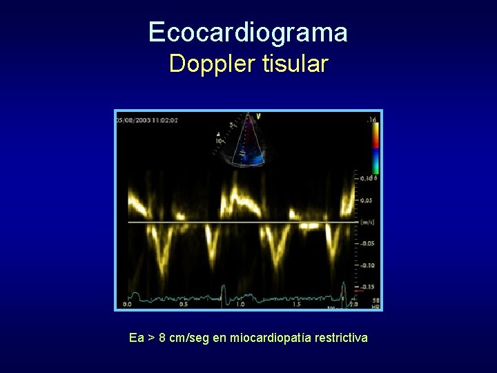 Ecocardiograma Doppler tisular Ea > 8 cm/seg en miocardiopatía restrictiva 